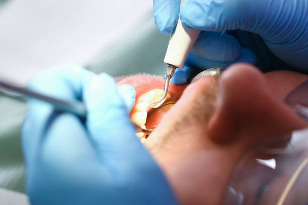 Best Knocked-Out Tooth (Avulsed Tooth) Treatment in Raleigh, NC